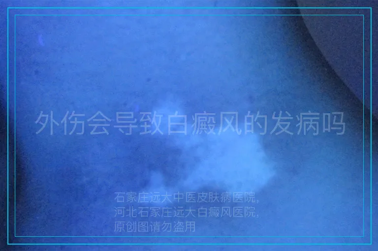 外伤会导致白癜风的发病吗