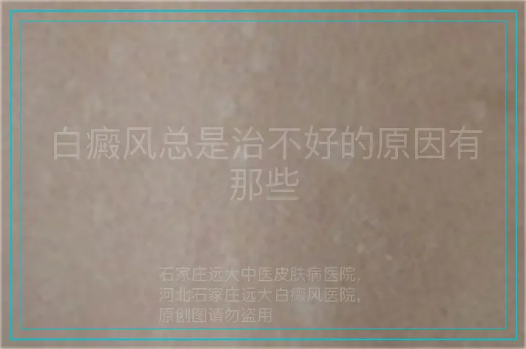 白癜风总是治不好的原因有那些