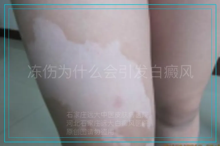 冻伤为什么会引发白癜风