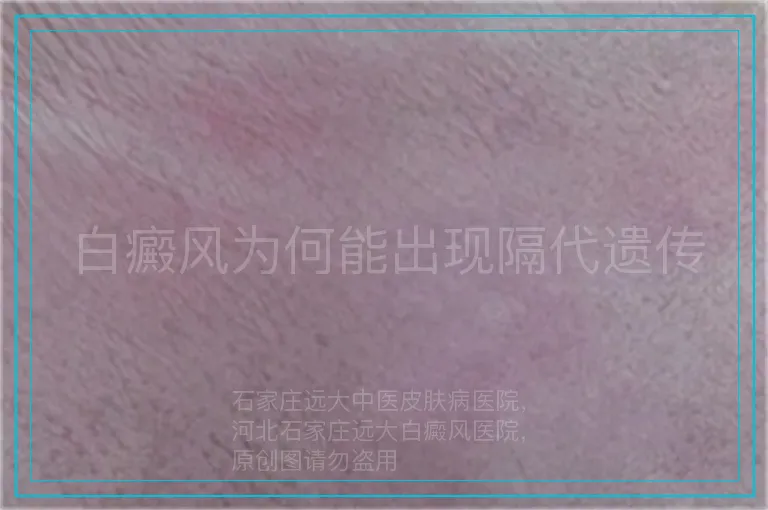 白癜风为何能出现隔代遗传