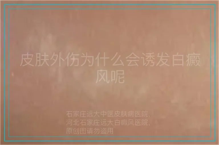 皮肤外伤为什么会诱发白癜风呢