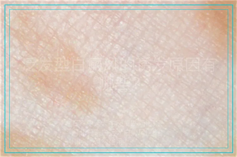 泛发型白癜风的诱发原因有哪些?