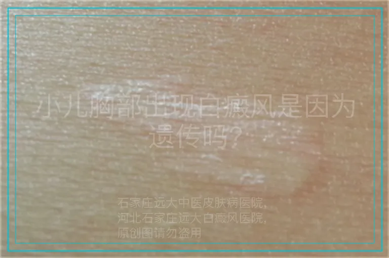 小儿胸部出现白癜风是因为遗传吗?