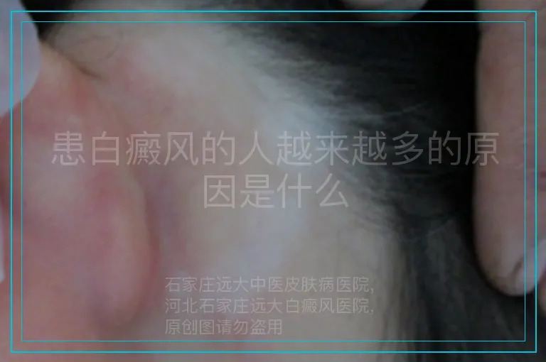 患白癜风的人越来越多的原因是什么