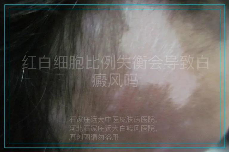 红白细胞比例失衡会导致白癜风吗