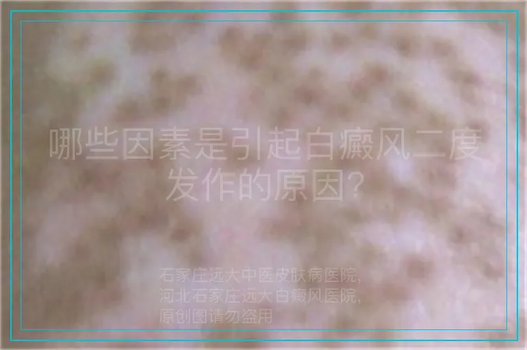 哪些因素是引起白癜风二度发作的原因?