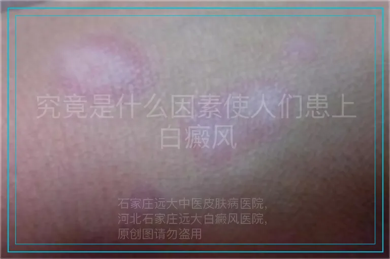 究竟是什么因素使人们患上白癜风