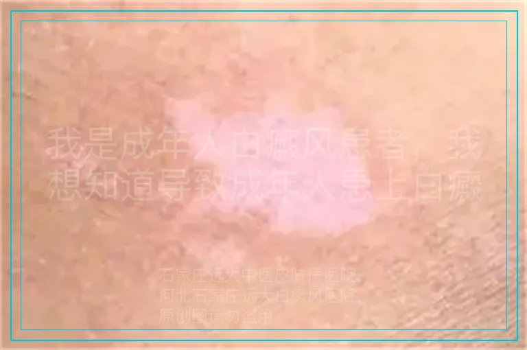 我是成年人白癜风患者，我想知道导致成年人患上白癜风的原因有哪些?