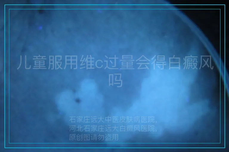 儿童服用维c过量会得白癜风吗