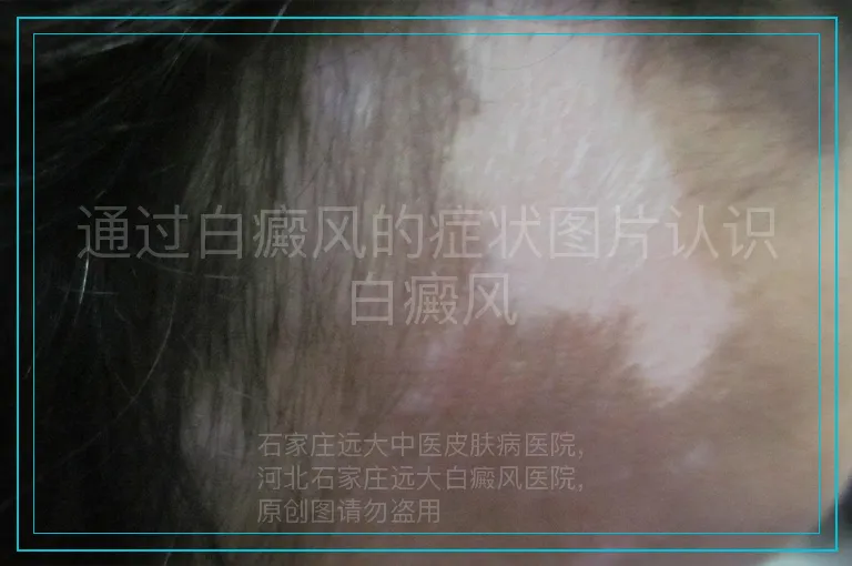 通过白癜风的症状图片认识白癜风