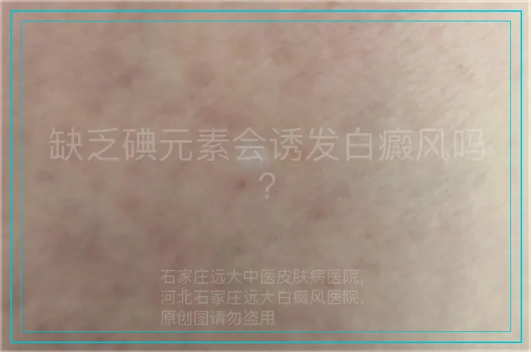缺乏碘元素会诱发白癜风吗?