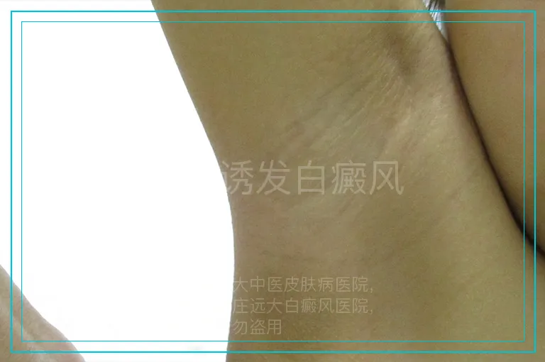 外伤诱发白癜风