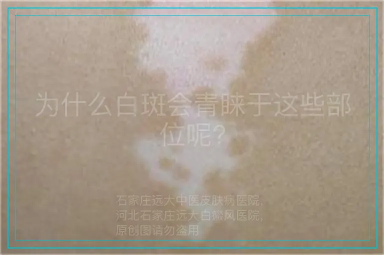 为什么白斑会青睐于这些部位呢?