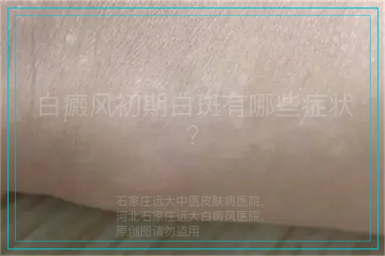 白癜风初期白斑有哪些症状？