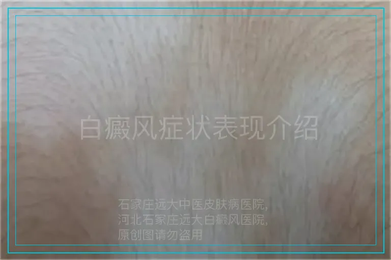 白癜风症状表现介绍