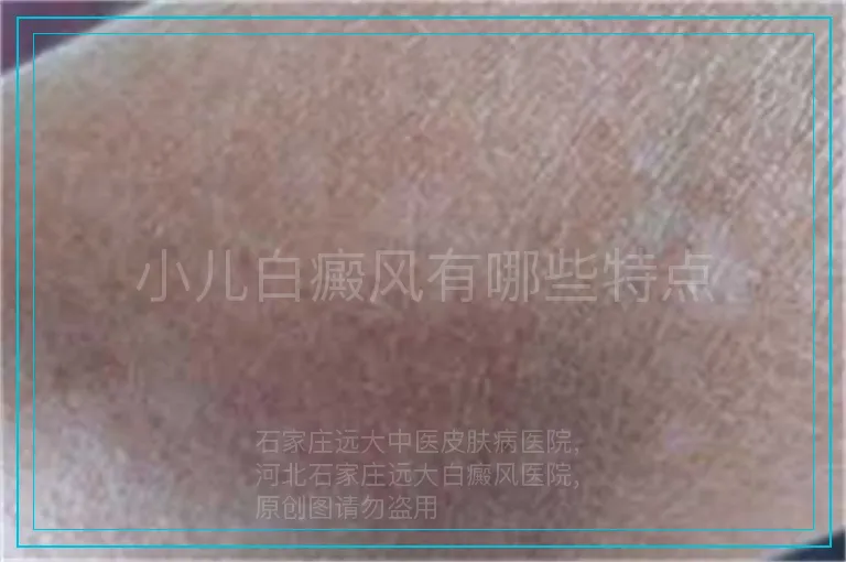 小儿白癜风有哪些特点