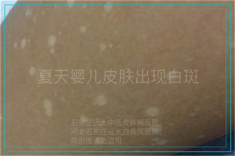夏天婴儿皮肤出现白斑