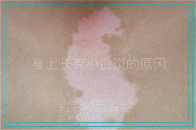 身上长有小白斑的原因