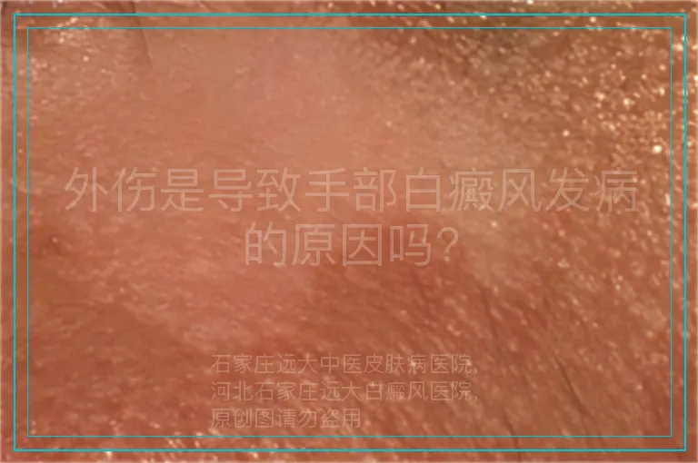 外伤是导致手部白癜风发病的原因吗?