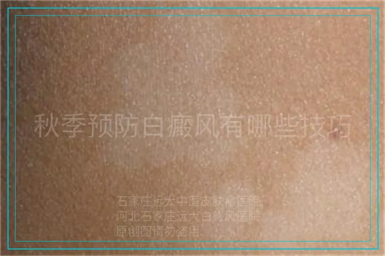 秋季预防白癜风有哪些技巧
