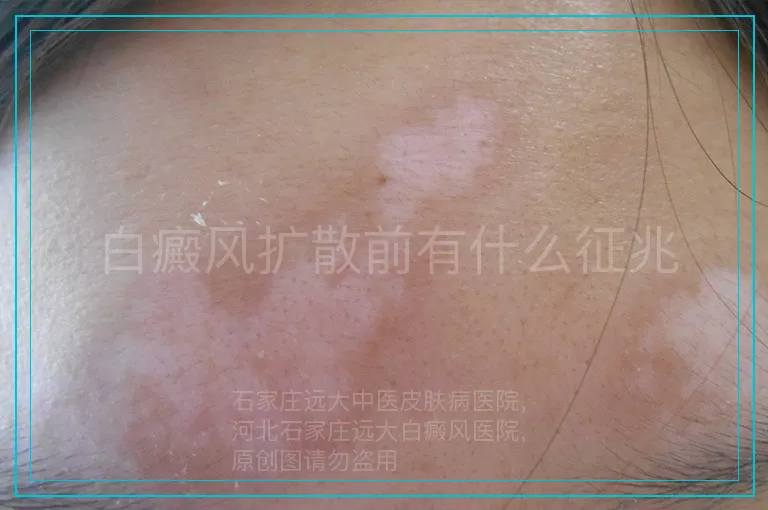 白癜风扩散前有什么征兆
