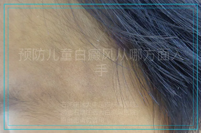 预防儿童白癜风从哪方面入手
