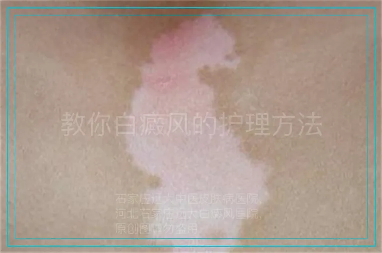 教你白癜风的护理方法