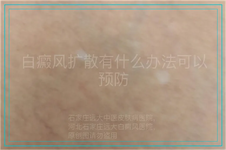 白癜风扩散有什么办法可以预防