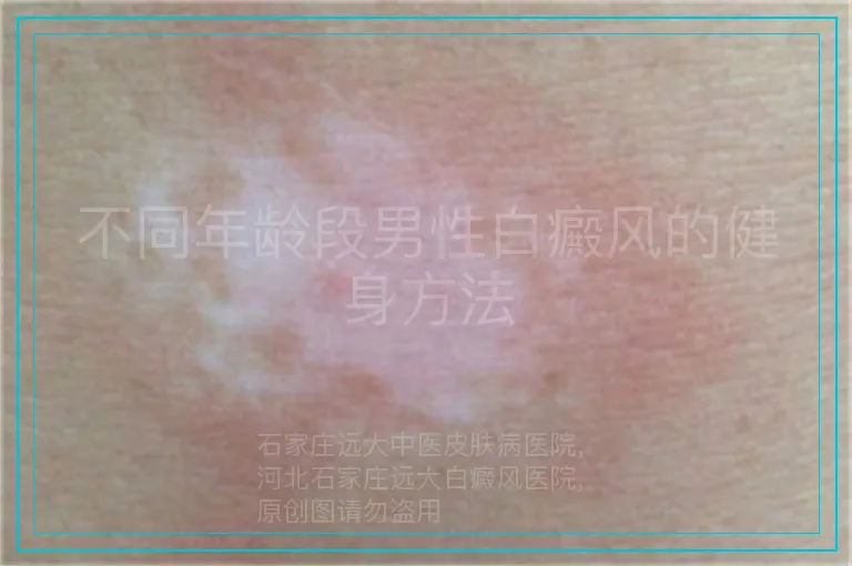 不同年龄段男性白癜风的健身方法