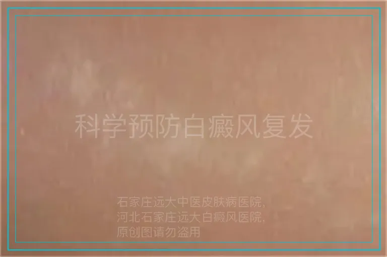 科学预防白癜风复发