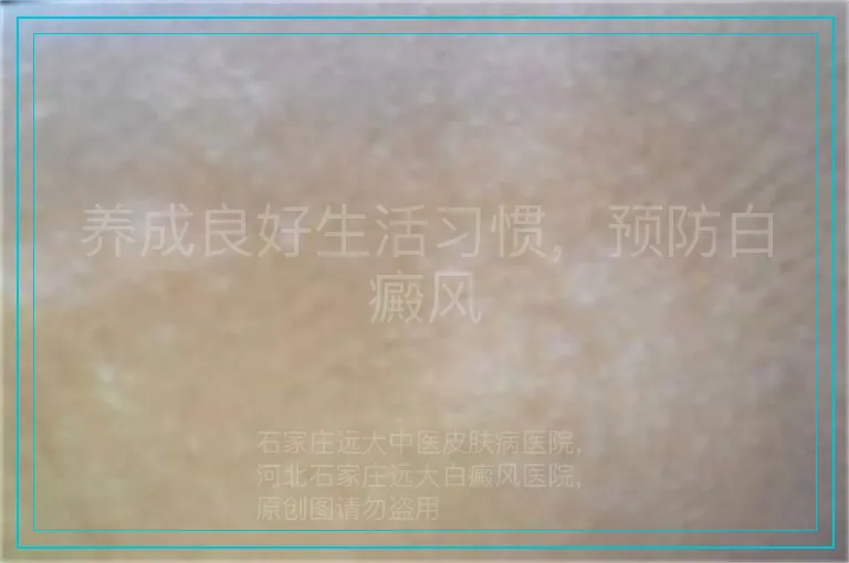 养成良好生活习惯，预防白癜风