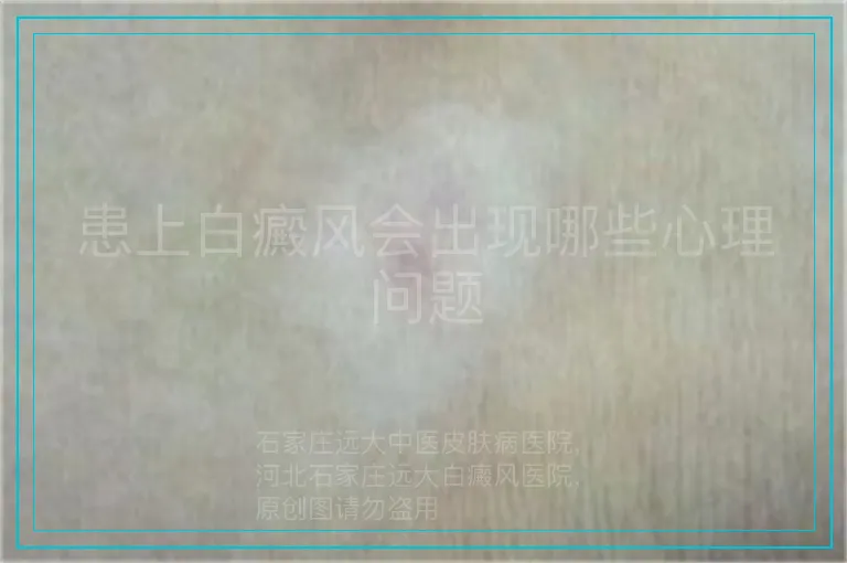 患上白癜风会出现哪些心理问题