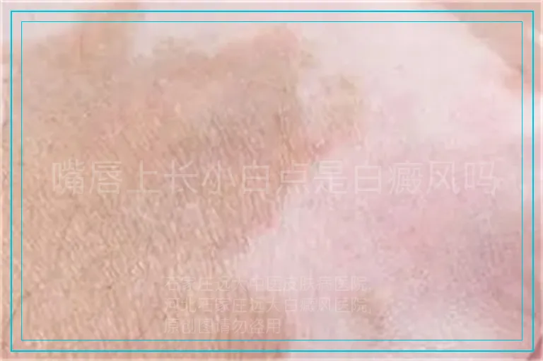 嘴唇上长小白点是白癜风吗