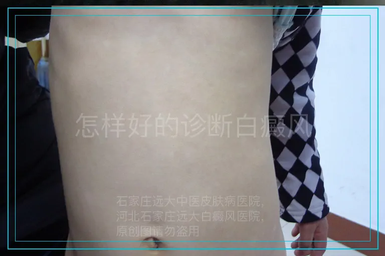怎样好的诊断白癜风