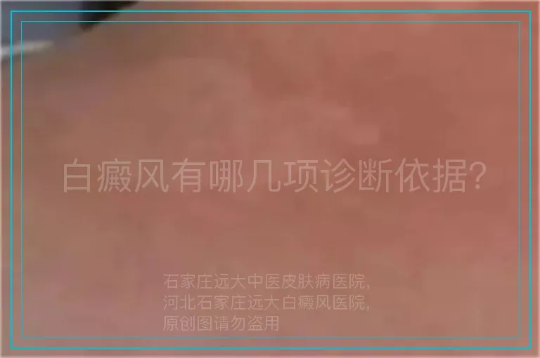 白癜风有哪几项诊断依据？
