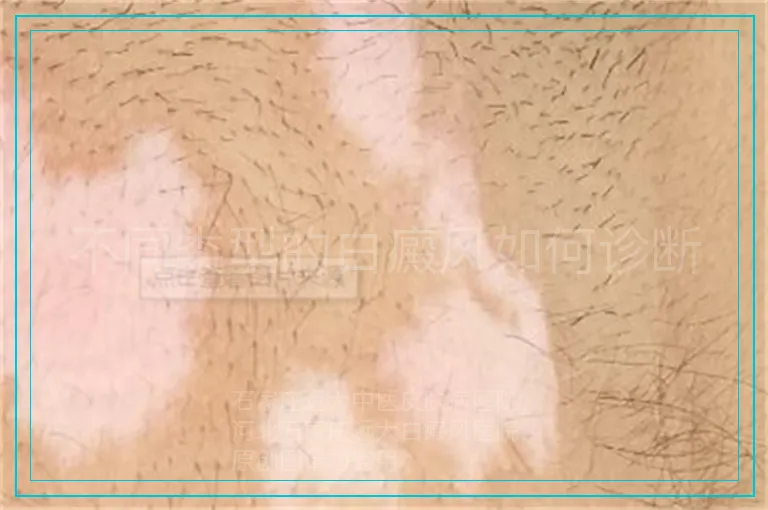 不同类型的白癜风如何诊断