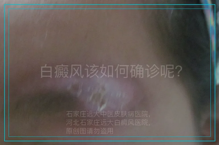 白癜风该如何确诊呢？