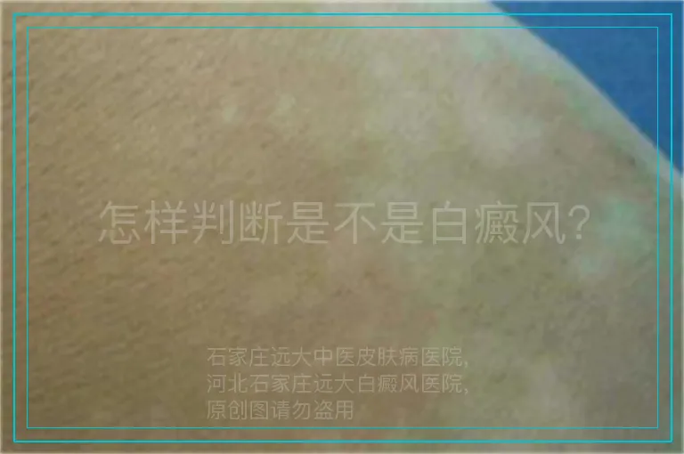 怎样判断是不是白癜风？