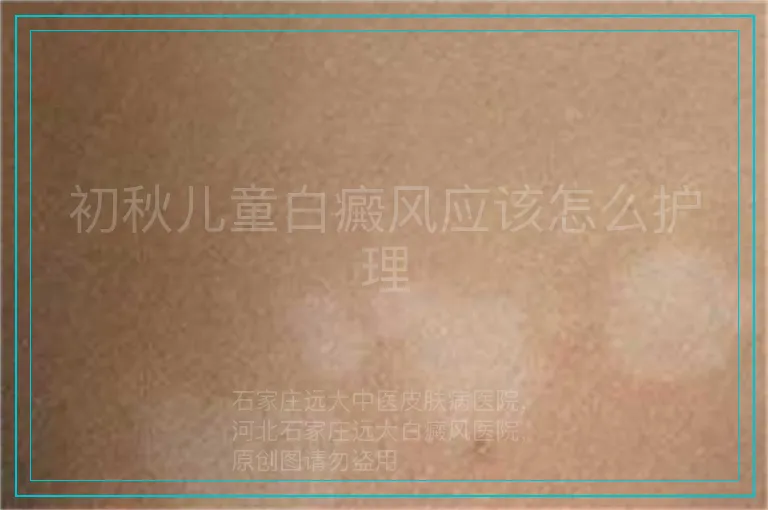 初秋儿童白癜风应该怎么护理