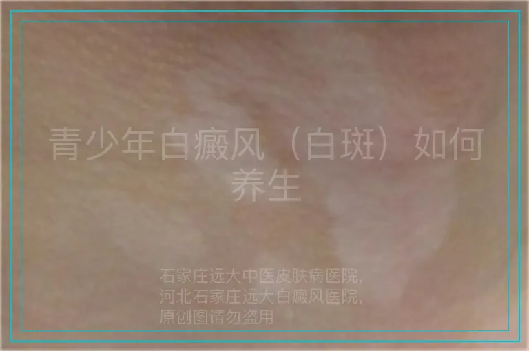 青少年白癜风（白斑）如何养生