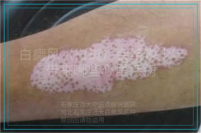 白癜风（白斑）会给青少年带来哪些心里疾病