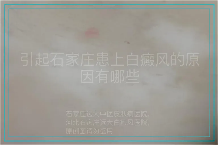 引起石家庄患上白癜风的原因有哪些