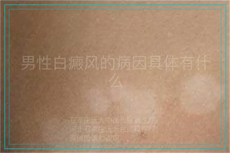 男性白癜风的病因具体有什么