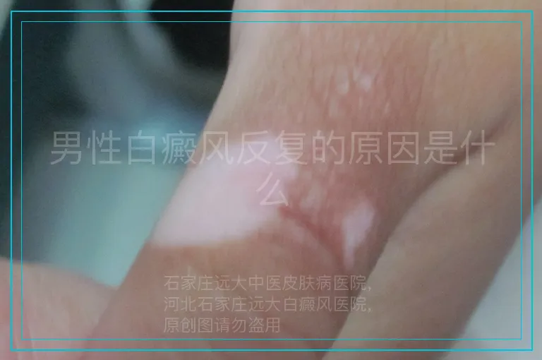 男性白癜风反复的原因是什么