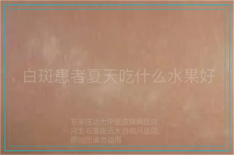 白斑患者夏天吃什么水果好