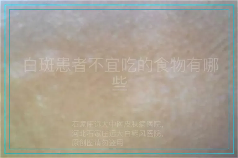 白斑患者不宜吃的食物有哪些