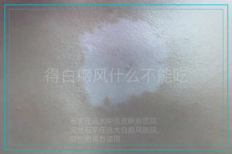 得白癜风什么不能吃