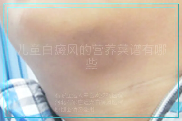 儿童白癜风的营养菜谱有哪些