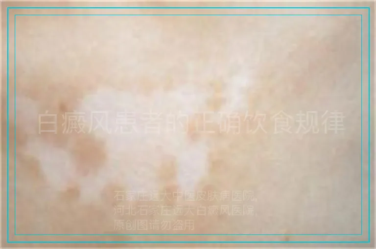 白癜风患者的正确饮食规律