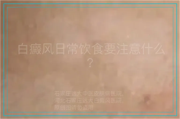 白癜风日常饮食要注意什么？